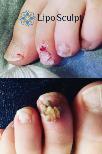 Wart removal customer results from Lipo Sculpt Longbridge